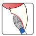 Osung Crown Anterior/ Lingual Reduction Flame FG Shank 257-25EC1 Extra Coarse (Super Coarse) Grit Diamond Bur 5/PK